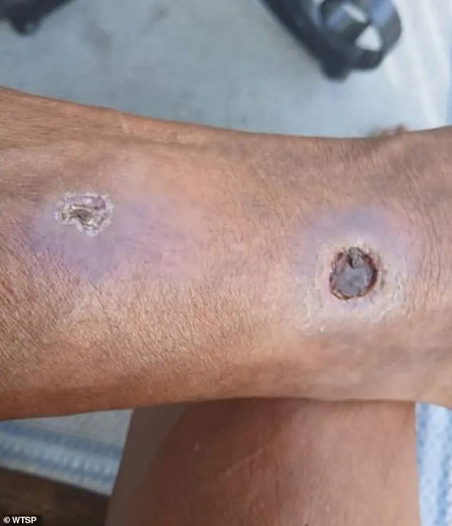 Largo Resident Sues Grand Oak Apartments Over Alleged Negligence in Addressing Spider Infestation Leading to Toe Amputation