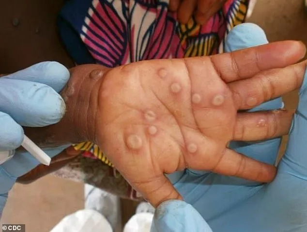 San Francisco Confirms First Case of More Dangerous Mpox Strain.