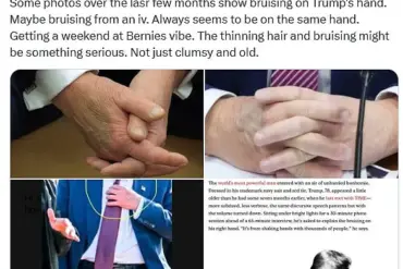 A Mysterious Bruise on President Trump's Hand Sparking Concerns