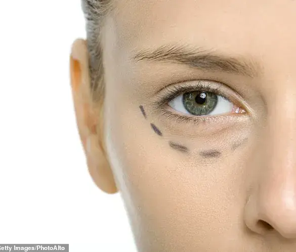 Blepharoplasty: The Swift Path to Refreshed Eyes