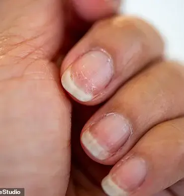 Your Nails May Be Warning You About Serious Health Issues