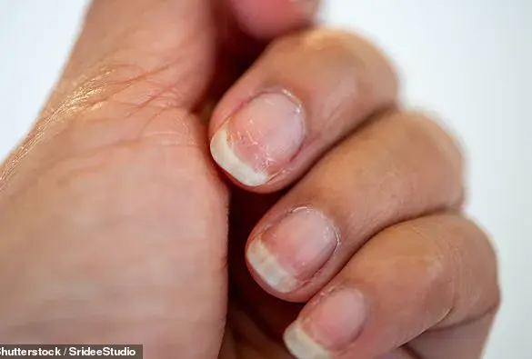 Your Nails May Be Warning You About Serious Health Issues
