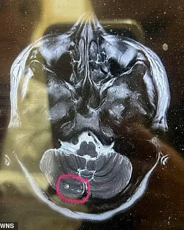 A Routine Botox Top-Up Left Amanda Wolaver Paralyzed: 'I Never Imagined This Nightmare'