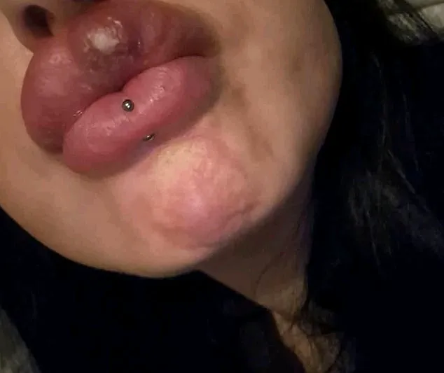 Mother's Nightmare: The Costly Journey of Aesthetic Treatments That Went Wrong